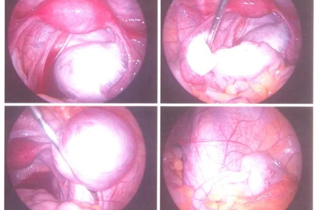 Options for Medical and Natural Treatment of Endometriosis